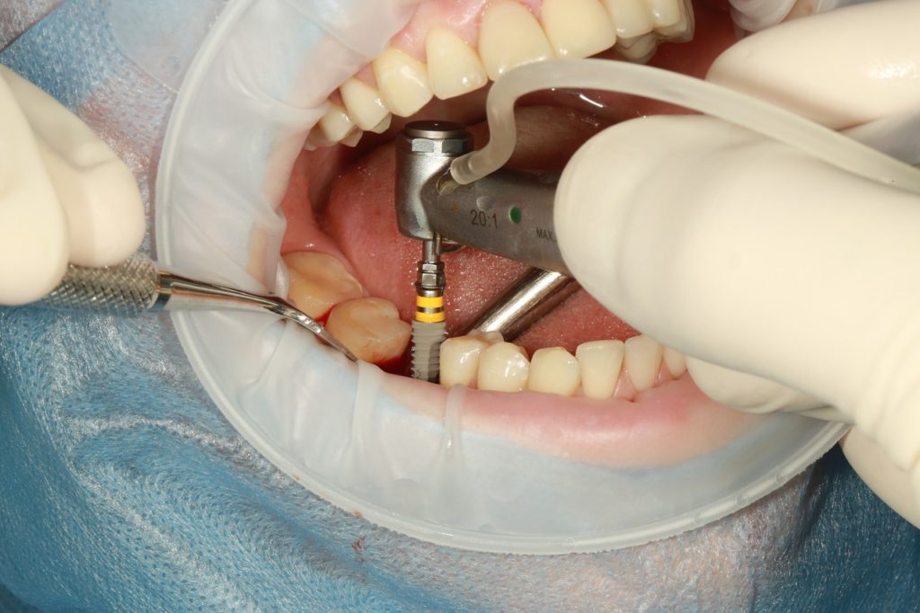Cómo limpiar implantes dentales fijos